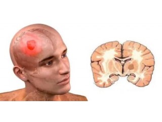 Мюстофоран в лікуванні дисемінованої меланоми шкіри та гліоми стовбура головного мозку
